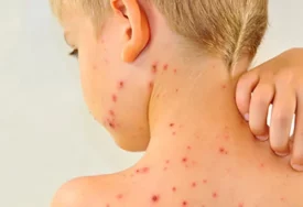 Najveća epidemija ospica u posljednjih 30 godina