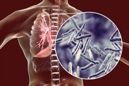 Tuberkuloza u 2021. najsmrtonosnija zarazna bolest u svijetu nakon COVID-a
