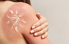 Jogurt na opekotine? Dermatolozi upozoravaju na ozbiljne rizike
