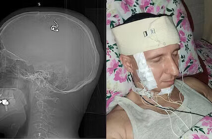 Istraživač implantirao čip u svoj mozak - u dnevnoj sobi
