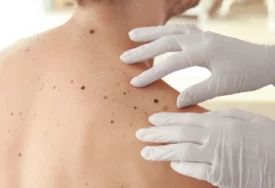 Više od 1.000 osoba godišnje u Hrvatskoj oboli od melanoma