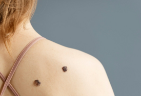 U FBiH godišnje se dijagnosticira oko 250 novih slučajeva melanoma