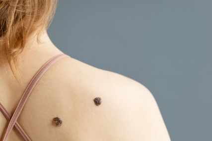 U FBiH godišnje se dijagnosticira oko 250 novih slučajeva melanoma