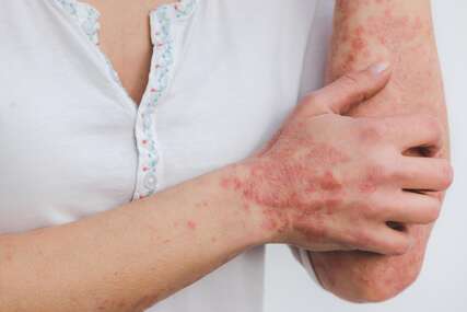 Istraživanje pokazalo: Stres iz djetinjstva povećava rizik od razvoja psorijaze