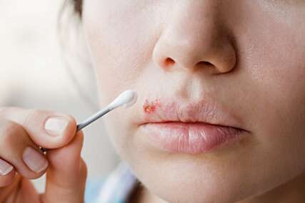 Kada herpes prestaje biti zarazan? Evo što trebate znati