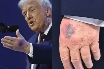Bijela kuća demantuje tvrdnje da je bolestan: Poznat uzrok modrica na Trumpovim rukama
