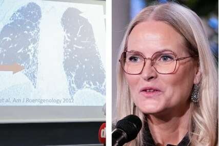 Norveška prineza morala na transplantaciju pluća. "Dobila sam dar života"